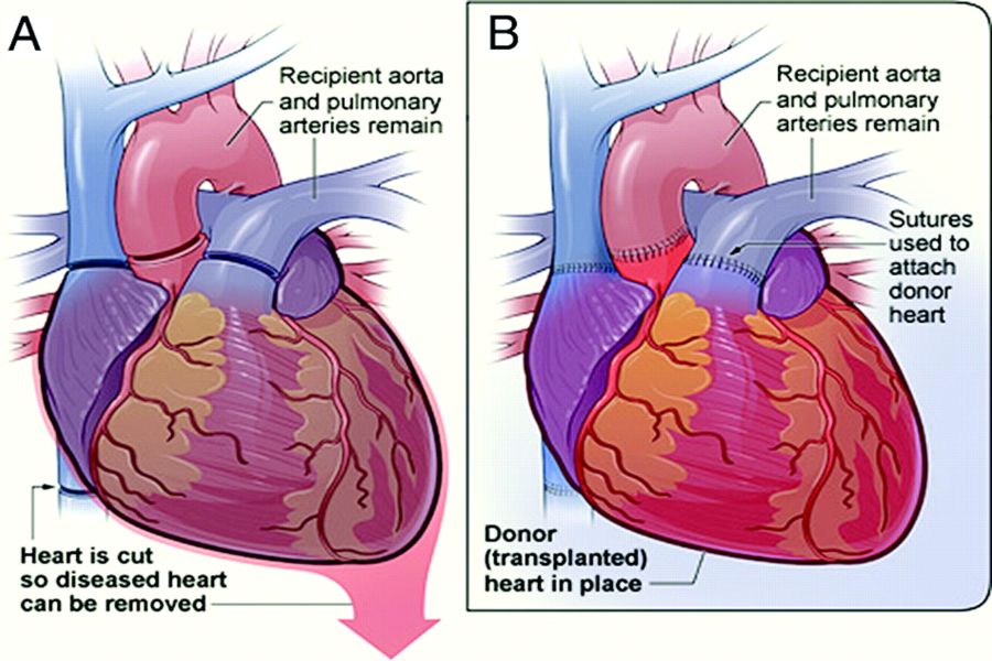 Heart Transplant 