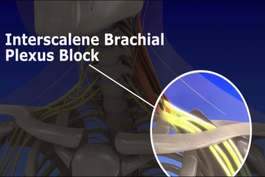 Brachial Plexus Injury