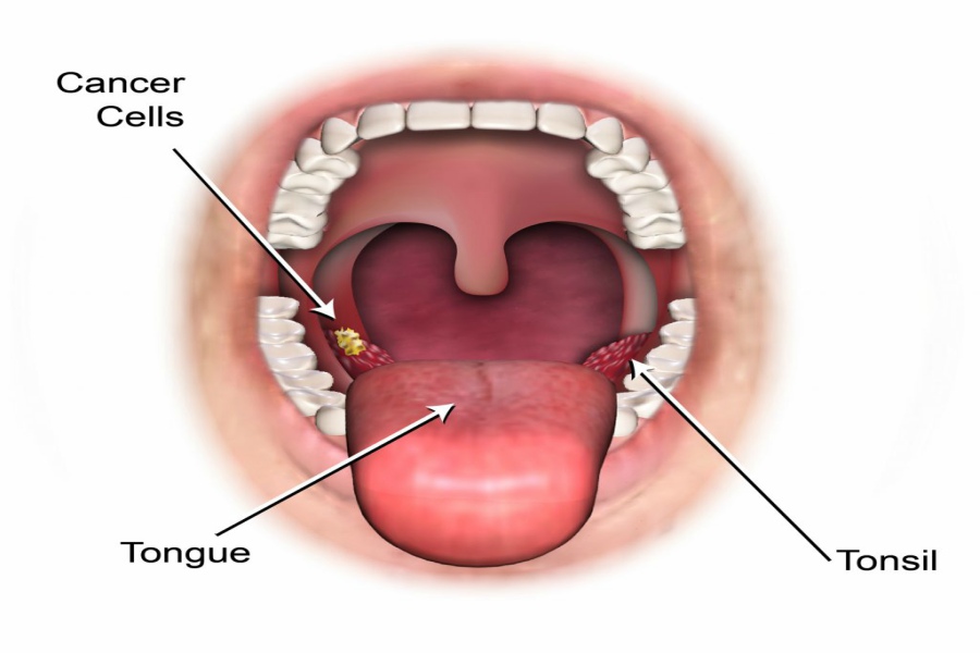 Oral Cancer Treatment