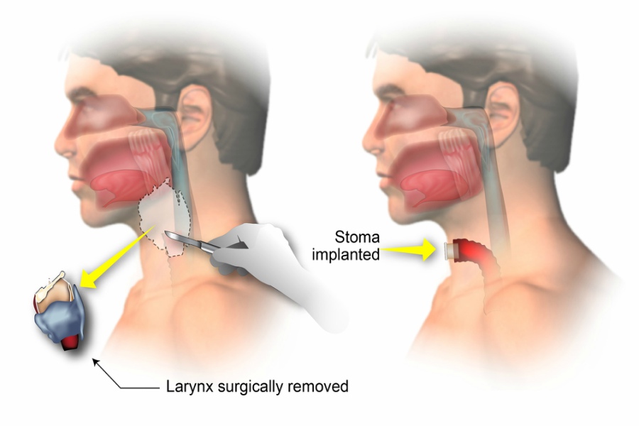 Laryngectomy 