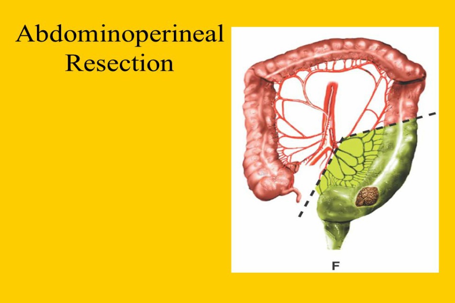 Abdominoperineal Resection 