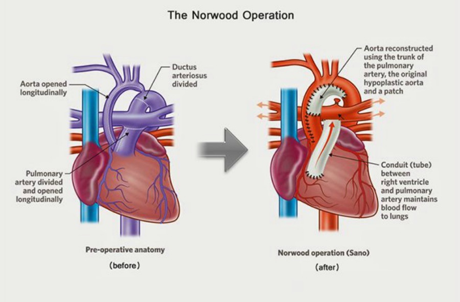 Norwood Procedure