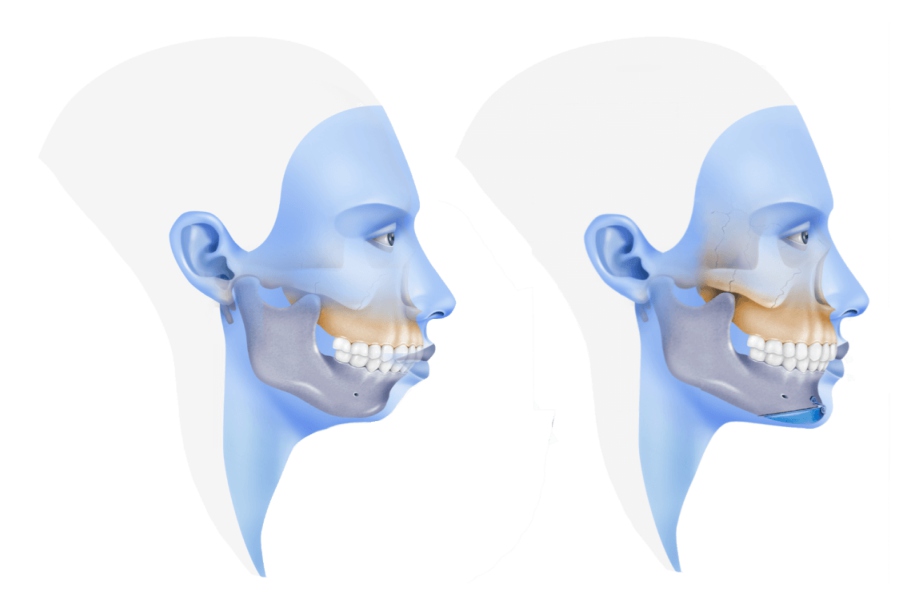 Mentoplasty / Chin Augmentation