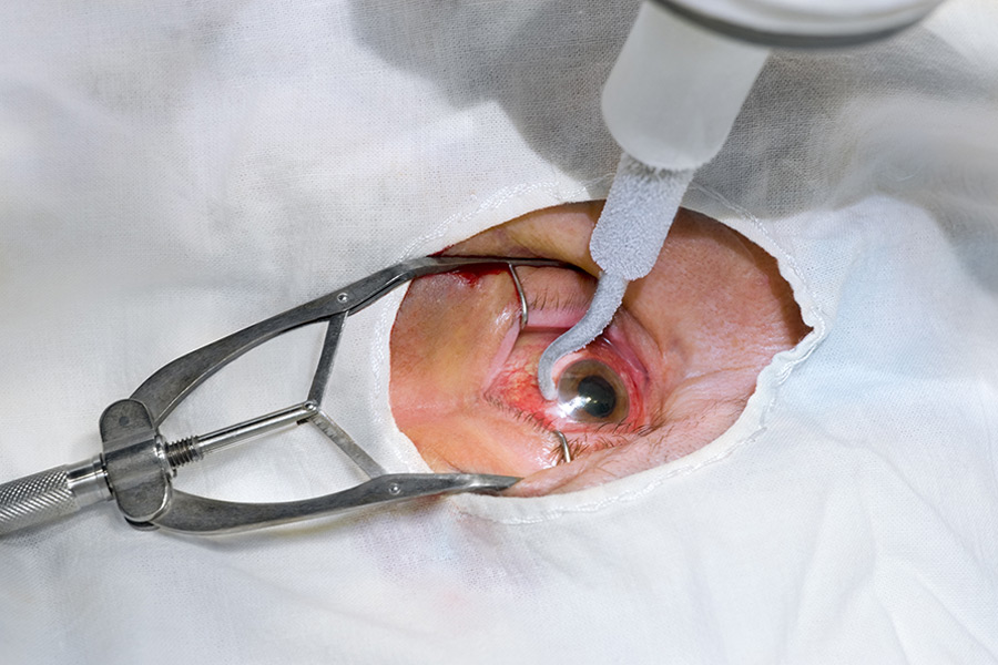  Retinal Detachment Surgery