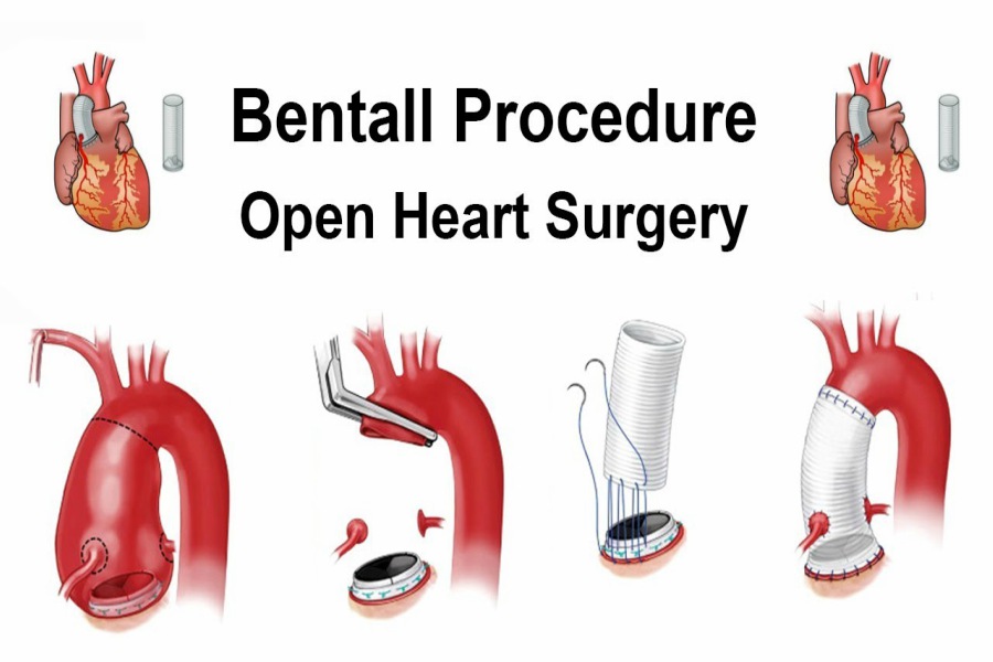 Bentall Surgery