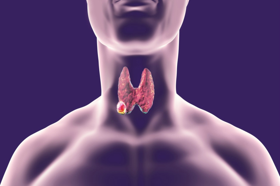 Thyroid Cancer Treatment