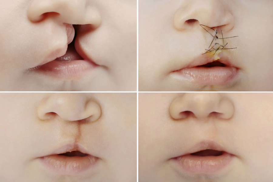 Cleft Lift and Palate