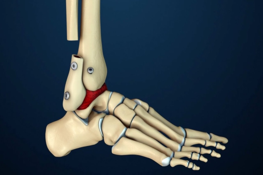 Ankle Fusion Surgery 